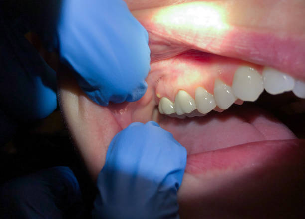 Best Dental Abscess Treatment in Benicia, CA