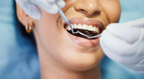 Best Emergency Wisdom Tooth Extraction in Benicia, CA
